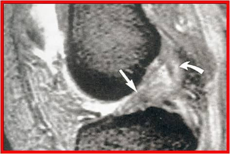 Ligamentoplastie 3